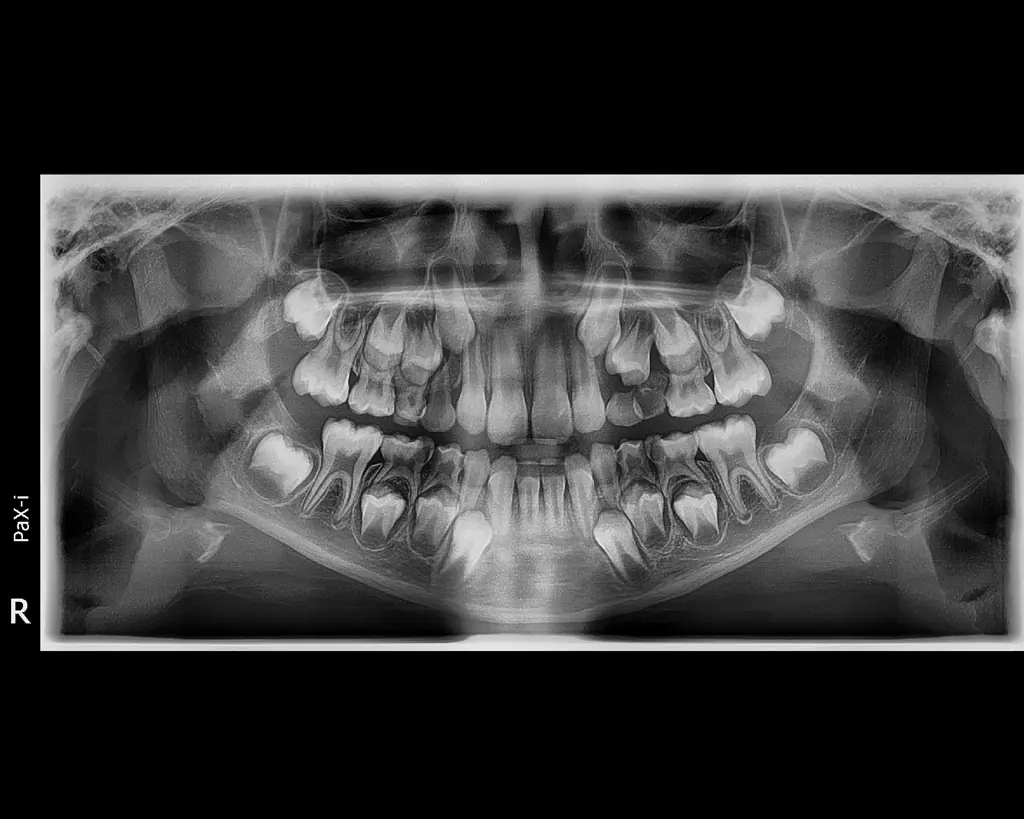 عکس تمام فک دندان کودکان