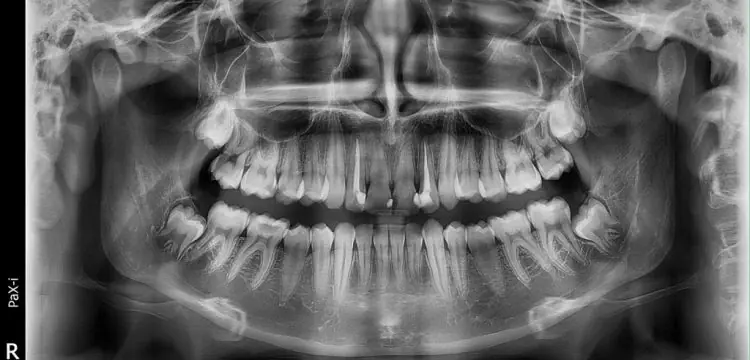 عکس دیجیتال تمام فک دندان