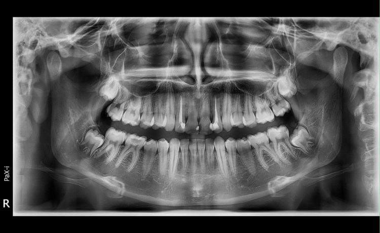 عکس دیجیتال تمام فک دندان